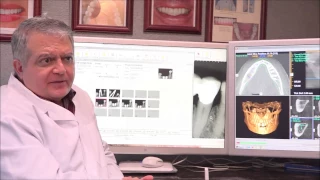 Can Dental Implants Get Cavities? | Dr Parsa Zadeh