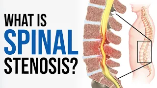 What is Spinal Stenosis? | Antonio Webb, MD