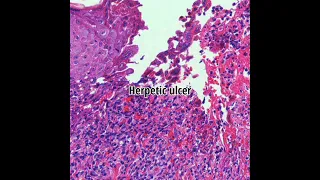 Histopathology of Herpes Simplex Infection  #shorts #dermpath #dermatopathology #virus