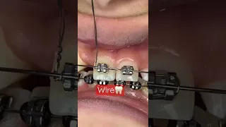 Orthodontic Treatment |Fixed Braces |Ligature,Power Chain |OrthoDentistry🦷