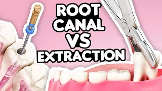 Root Canal vs. Tooth Extraction: What’s the Right Choice?