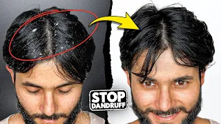 How to Cure DANDRUFF (100% Works)