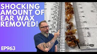 The Most Shocking Ear Wax Removal Ever - EP963