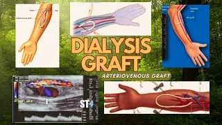AV Graft | Arteriovenous Graft | Placement of an AV Graft | Creation of an Arteriovenous Graft