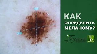 МЕЛАНОМА - КАК РАСПОЗНАТЬ и не допустить развития рака кожи. Дерматоскопия и Фотодерматоскопия.