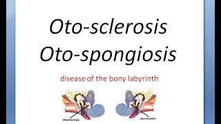 ENT Otosclerosis Part 1 OtoSpongiosis Autosomal Dominant carhart osteogenesis imperfecta Schwartze