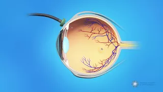 Vitrectomy Surgery for Macular Holes