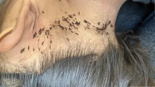 Remove all thousand lice from her hair - Pick out all of big lice from her head