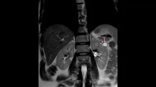 What does a kidney cyst look like on MRI?