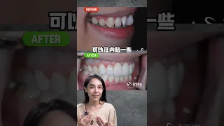 做陶瓷貼片真得只要磨一點點牙嗎？#超薄陶瓷貼片#牙齒美白