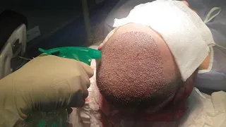 hair transplant in Bellus clinic  пересадка волос 5000 графтов