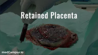 Retained Placenta Management