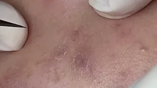 SAC DEP SPA Blackheads | #695