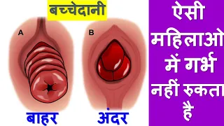 महिलाओ में बच्चेदानी  बाहर आने पर गर्भ  नहीं रुकता है| UTERINE PROLAPSE | Reason & Treatment|