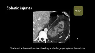 Dr Mamdouh Mahfouz the acute radiology Abdominal trauma