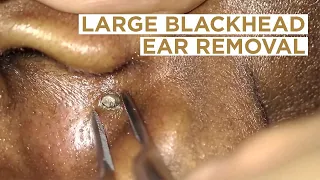 Large blackhead removed from the ear | Dr Cameron McIntosh