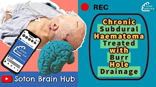 Subdural Haematoma Surgery