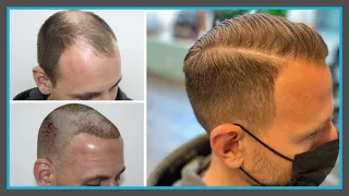 Haartransplantation Türkei ✅ VORHER - NACHHER mit 3750 Grafts | Health Travels [Dr. Gökhan Gür]