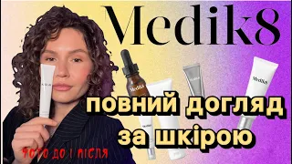 Догляд за шкірой . Огляд бренду Medik8 .Фото до і після