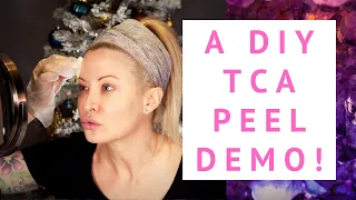 DIY 25% TCA Peel How To Demo