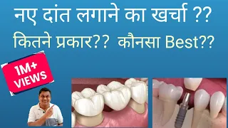 नए दांत लगाने का खर्चा? |डेंटल इंप्लांट या डेंटल ब्रिज |Dental Implants Vs Dental Bridge |Cost