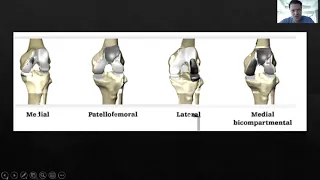 UOI Community Lecture Series - Partial Knee Replacement