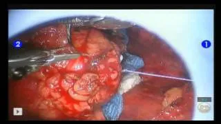 Robotic Partial Nephrectomy with a Renal Suspension Stitch at COH