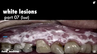 white lesions || lichen planus 2 || oral medicine _ عزت شومان