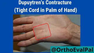 Dupuytren's Contracture (Tight Cord in Palm of Hand)