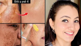 कितनी भी मुश्किल *झाइयाँ MELASMA HYPERPIGMENTATION* हों , करें 100% इलाज़ सिर्फ 1 हफ्ते में