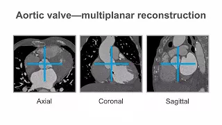 How to evaluate the aortic valve using cardiac CT imaging.