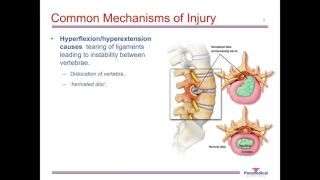 Spinal Injuries