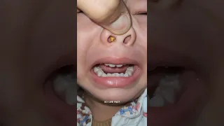 Something Stuck In Nose 😵  | How Doctor Remove It |        #shorts