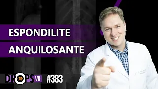 ESPONDILITE ANQUILOSANTE