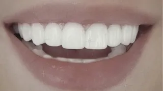 "did you get braces?" - straight teeth subliminal