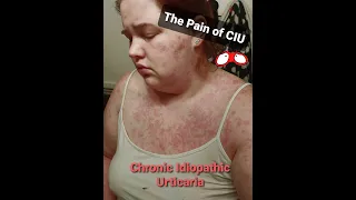 I have CIU - Chronic Idiopathic Urticaria