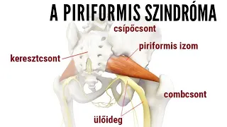 Piriformis szindróma