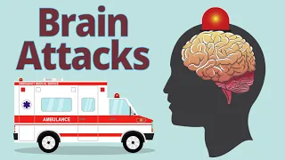 How Stroke Affects the Brain