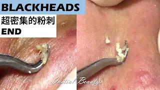 超密集的粉刺(blackheads) END - Taiwan Tainan台南清粉刺最乾淨