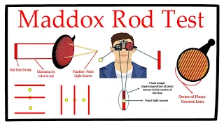 Maddox Rod Test- A Complete Tutorial