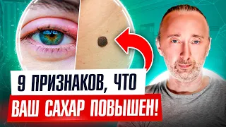 Как Ваша КОЖА говорит, что у Вас повышен сахар, или УЖЕ есть сахарный диабет 2 типа! Вот 9 ЗНАКОВ!