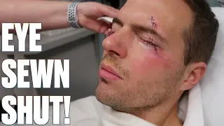 EYE SEWN SHUT AFTER SURGERY | CRAZY STITCHES AFTER SURGERY TO REMOVE MASS UNDER MY EYE