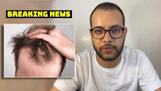 HUGE News for People with Extensive Hair Loss