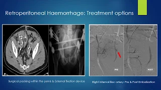 Haemorrhage control.  Zirpe Kapil