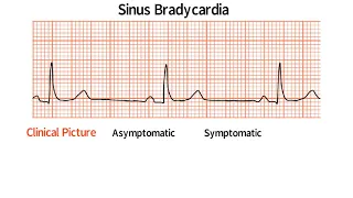 English- USMLE step 2 CK- Bradyarrhythmia- Ahmed Abdelrahman& Mohamed Samir Mousa