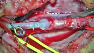 High flow bypass for trapping a giant right carotid cavernous aneurysm