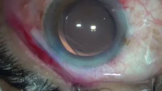 IMMATURE SENILE CATARACT