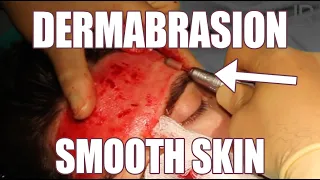 Dermabrasion for Smooth Skin, Acne Scars Treatment, and Smaller Pores