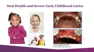 Webinar: Promoting Use of Childhood Dental Benefits Covered Under Medicaid & CHIP (2/18/21)