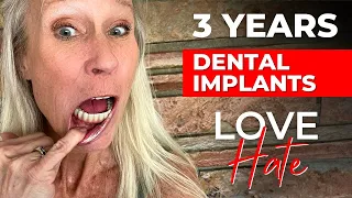 The Good And Bad Of My Dental Implants After 3 Years!